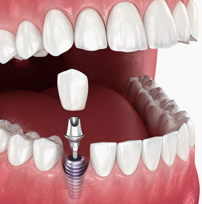 신사역임플란트 잘하는 신성치과 특징 4가지 <필독> 관련 이미지 4