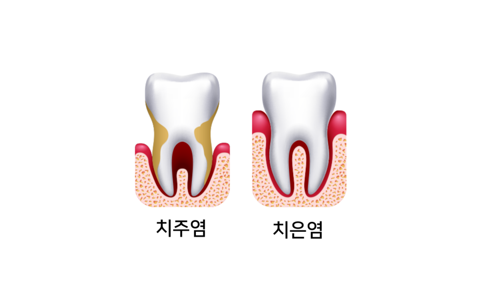 잠원동치과 신성치과, 잇몸이 붓는 이유 관련 이미지 7