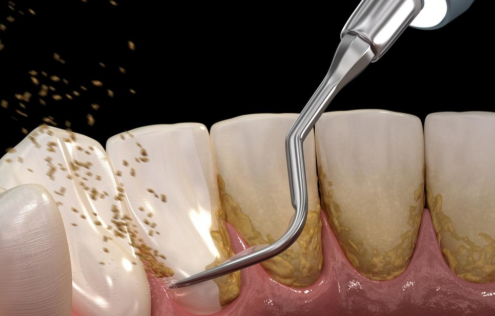 4 Things You Need to Know About Tooth Erosion If You Don’t Want to Get Into Trouble at Sinsa Station Dental Clinic image 12
