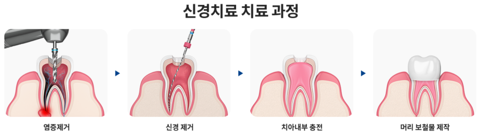 서초구치과 충치 치료 확실히 끝내고 싶다면 이것 보세요 관련 이미지 9