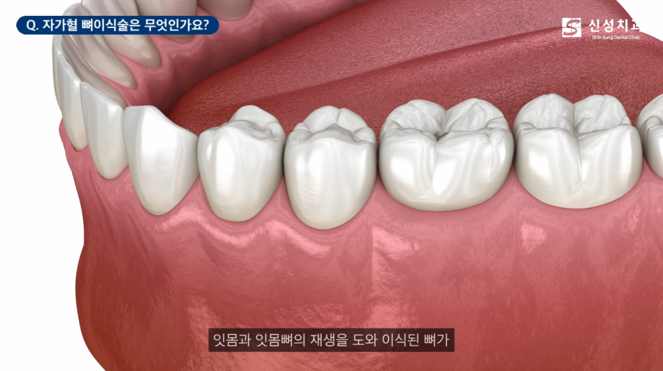 신사역임플란트 잘하는 신성치과 특징 4가지 <필독> 관련 이미지 9