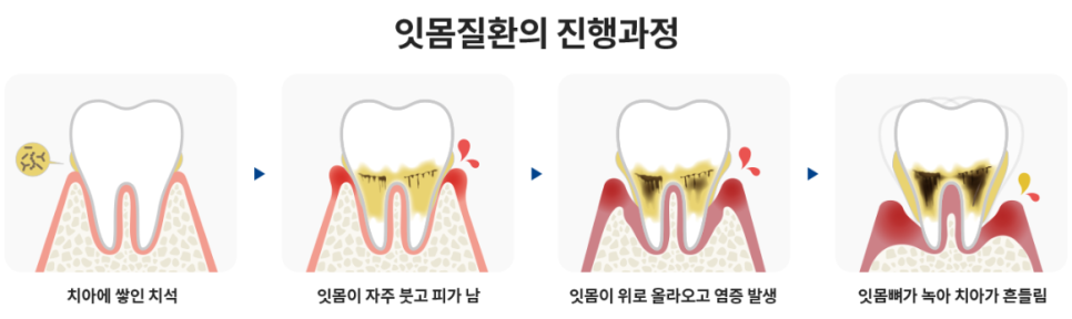 잠원동치과 신성치과, 잇몸이 붓는 이유 관련 이미지 5