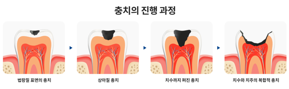 서초구치과 충치 치료 확실히 끝내고 싶다면 이것 보세요 관련 이미지 5