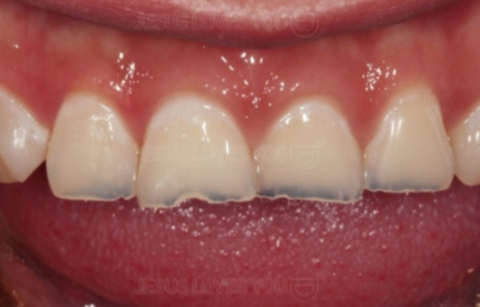 4 Things You Need to Know About Tooth Erosion If You Don’t Want to Get Into Trouble at Sinsa Station Dental Clinic image 9