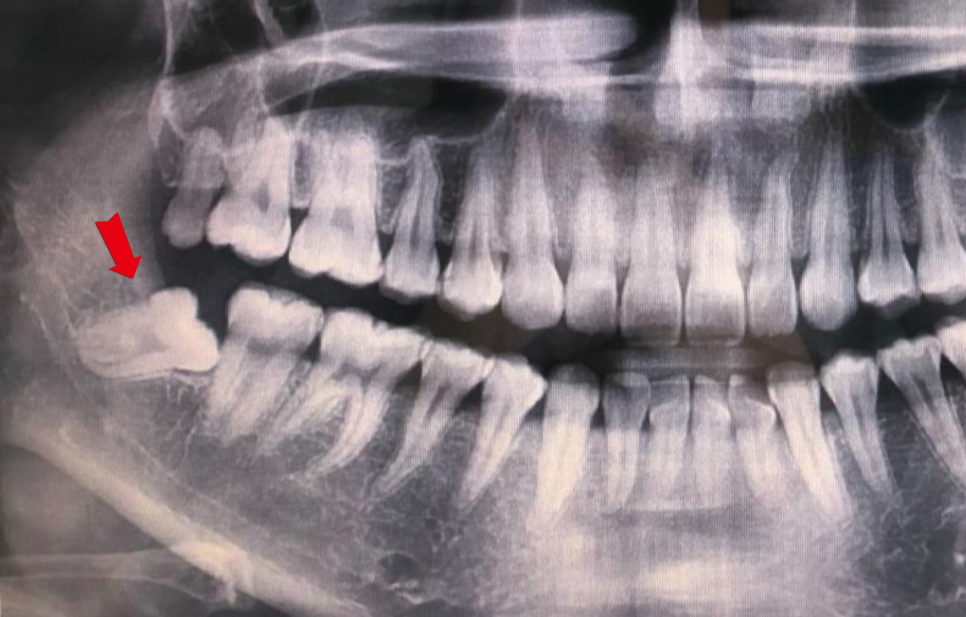 Jamwon-dong Dental Clinic Shinseong Dental: 4 Reasons You Should Not Leave Wisdom Teeth Untreated image 2