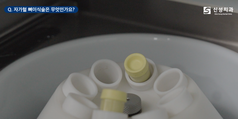 잠원동치과 임플란트 뼈이식 성공을 위한 2가지 방법 관련 이미지 2