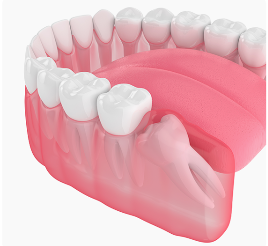 잠원역치과 신성치과 사랑니 발치 전 꼭 알아야 하는 3가지 관련 이미지 2
