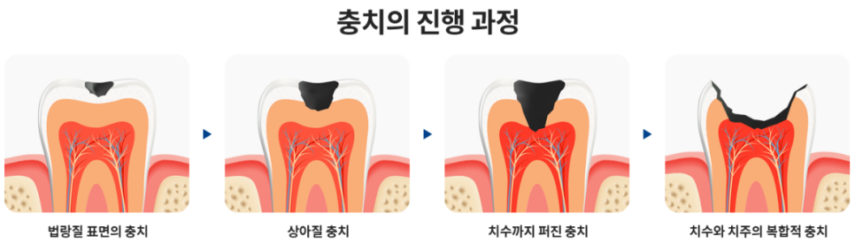 논현역치과 신성치과 충치 치료도 제대로 받아야 합니다. 관련 이미지 5
