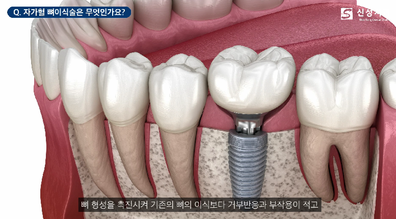 잠원동치과 임플란트 뼈이식 성공을 위한 2가지 방법 관련 이미지 4