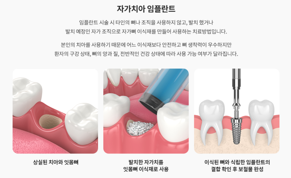 잠원동치과 임플란트 뼈이식 성공을 위한 2가지 방법 관련 이미지 5