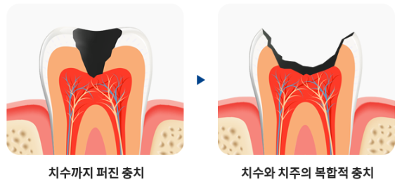 신사역치과 충치 치료 관련 이미지 7
