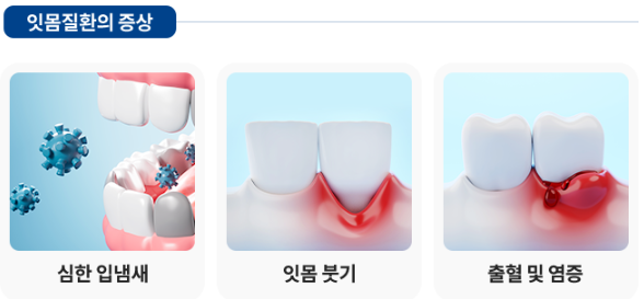 잠원동치과 신성치과, 잇몸이 붓는 이유 관련 이미지 4