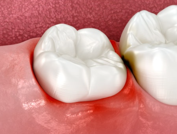 Jamwon-dong Dental Clinic Shinseong Dental: 4 Reasons You Should Not Leave Wisdom Teeth Untreated image 6