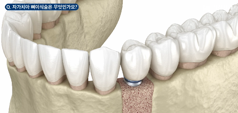 잠원동치과 임플란트 뼈이식 성공을 위한 2가지 방법 관련 이미지 7