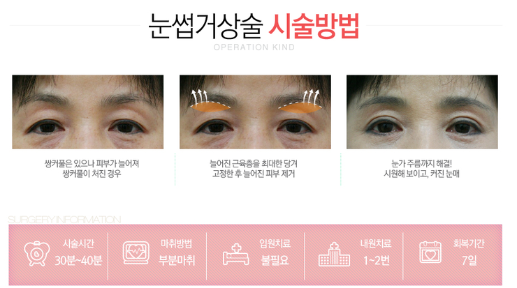 [까치산성형외과 로드성형외과에서 알려드리는 눈썹거상술 정보 ♬] 관련 이미지 3