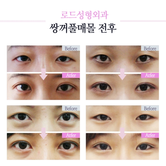 로드성형외과 쌍꺼풀매몰로 자연스럽게 달라지는 이미지! 관련 이미지 4