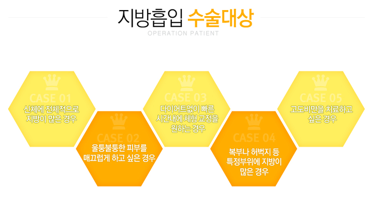 [화곡동성형외과 로드성형외과에서 알려드리는 지방흡입 정보 ♬] 관련 이미지 2