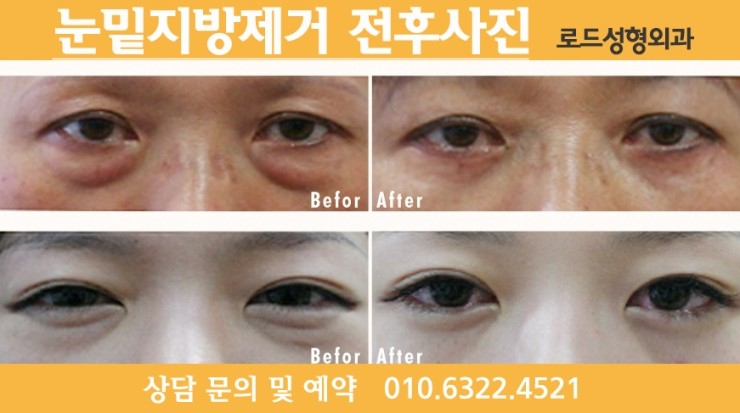 강서구성형외과 눈밑을 책임지다 관련 이미지 3