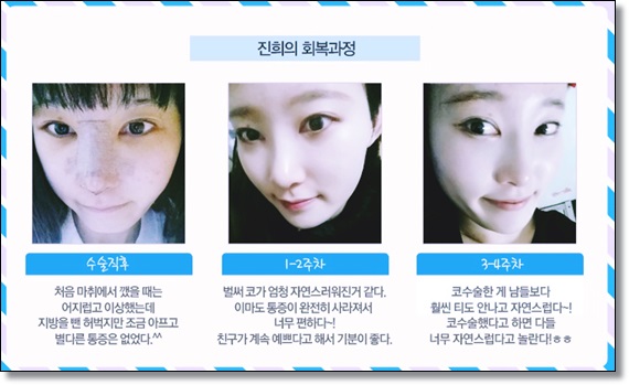 강서구코성형 빠른 회복으로 관련 이미지 2