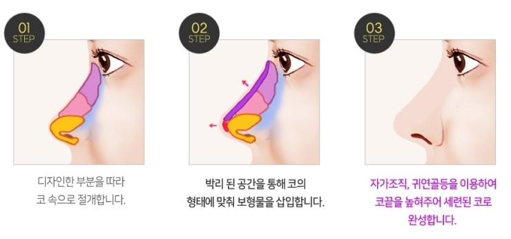 강서구코성형 로드에서 오똑하게 관련 이미지 3