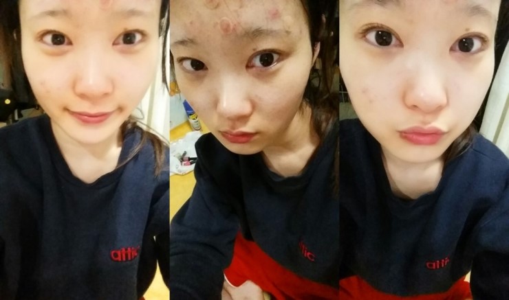 [로드성형외과] 진희의 이마지방이식, 코성형 후기! 관련 이미지 4