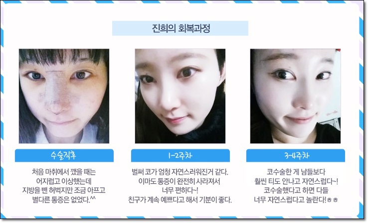 강서구코성형으로 원하는 스타일을 찾자! 관련 이미지 3