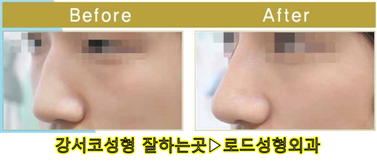 [로드성형외과] 강서코성형 잘하는곳! 관련 이미지 3