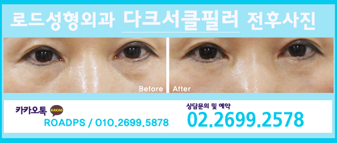 화곡동눈밑필러 부담갖지 않으셔도 됩니다! 관련 이미지 2
