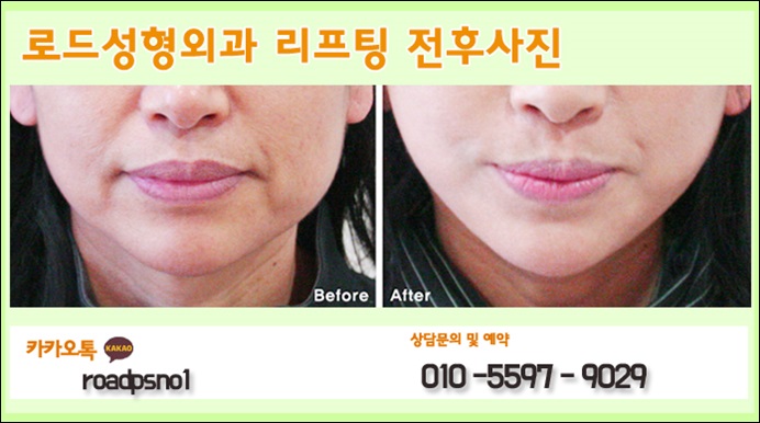 화곡동리프팅 관리포인트 캐치 관련 이미지 3