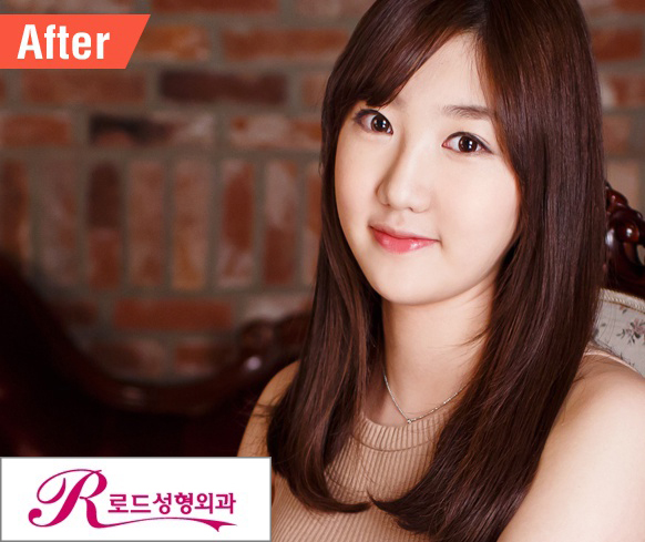 까치산역쌍꺼풀수술은 로드에서 만족! 관련 이미지 4