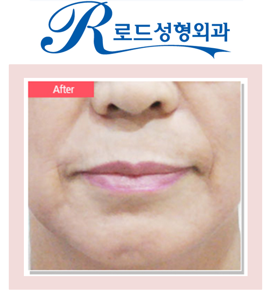 [까치산성형외과 로드성형외과에서 알려드리는 V리프팅 정보 ♬] 관련 이미지 4