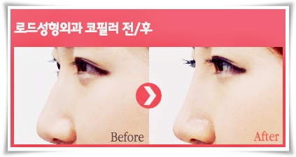 목동코필러로 아무도 몰라보게 관련 이미지 3