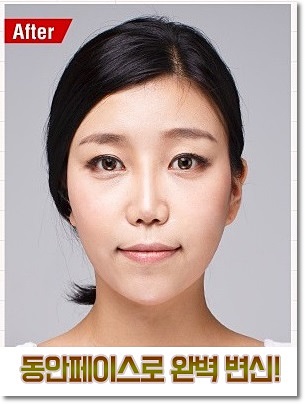 까치산역지방이식 환한 느낌으로 관련 이미지 4