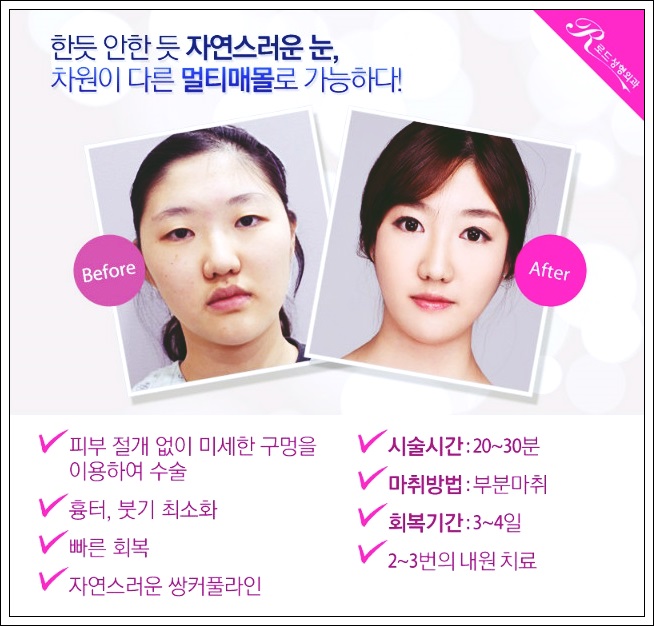 화곡동쌍꺼풀수술 티안나게 만들기 관련 이미지 4