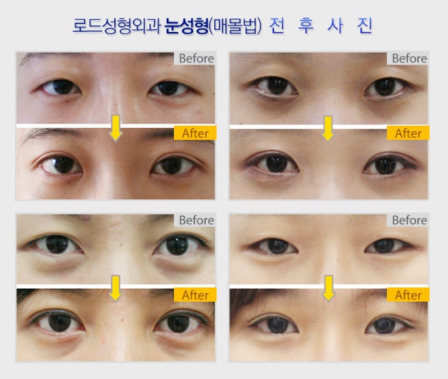 목동역쌍꺼풀수술 로드성형외과가 책임집니다. 관련 이미지 3