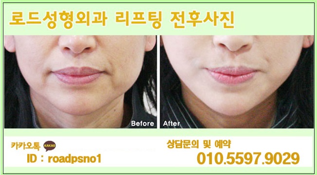 까치산역리프팅으로 흉터없는 시술하기 관련 이미지 4