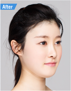 화곡역코필러 단기간에 효과보기 관련 이미지 3