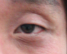 [로드성형외과] 강서구비절개눈매교정 ♬ 비절개눈매교정 로드성형외과 관련 이미지 4