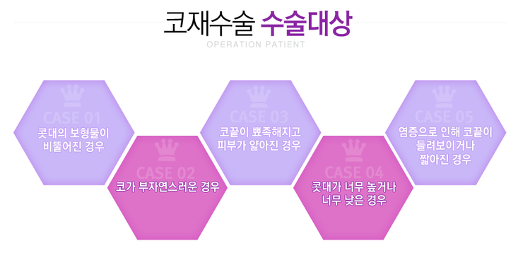 [까치산역성형외과 로드성형외과에서 알려드리는 코재수술 정보 ♬] 관련 이미지 2