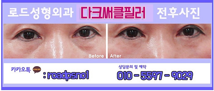 강서구눈밑필러 밝은 눈매 완성 관련 이미지 2