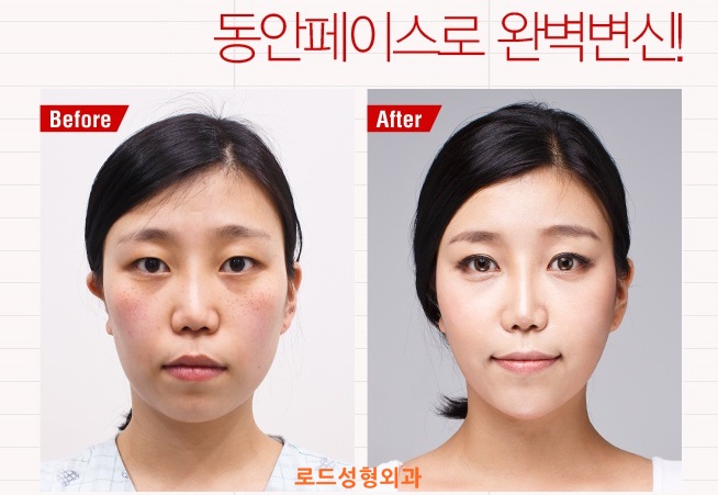 화곡역지방이식으로 젊은모습 관련 이미지 3