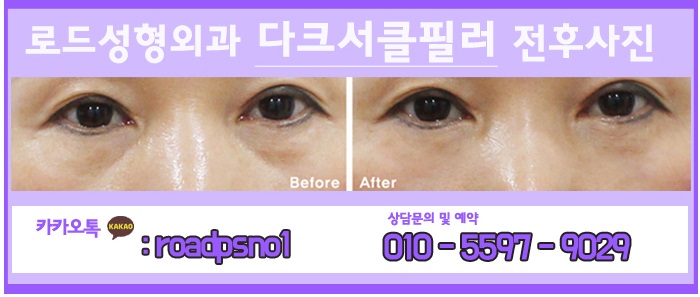 까치산역눈밑필러 칙칙한 눈매 살리기 관련 이미지 2