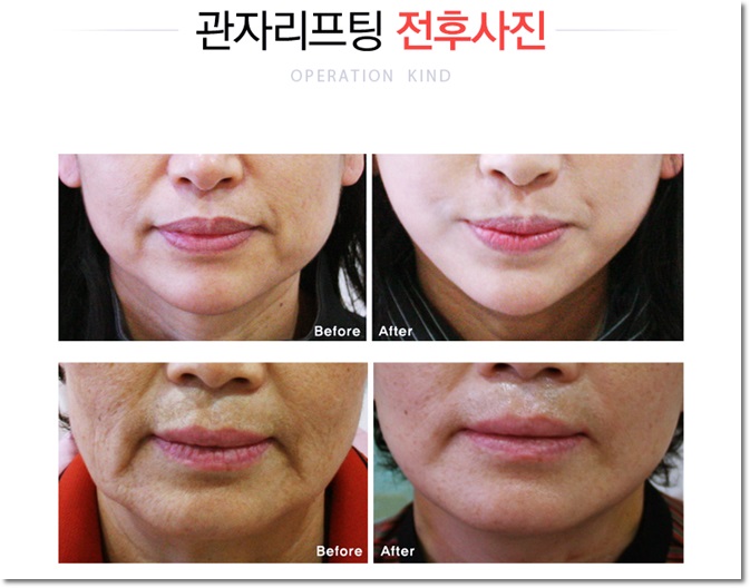 화곡동리프팅으로 색다른 변화를 관련 이미지 3