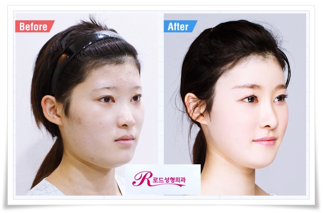 화곡동코재수술 불안감을 떨쳐버리세요! 관련 이미지 4