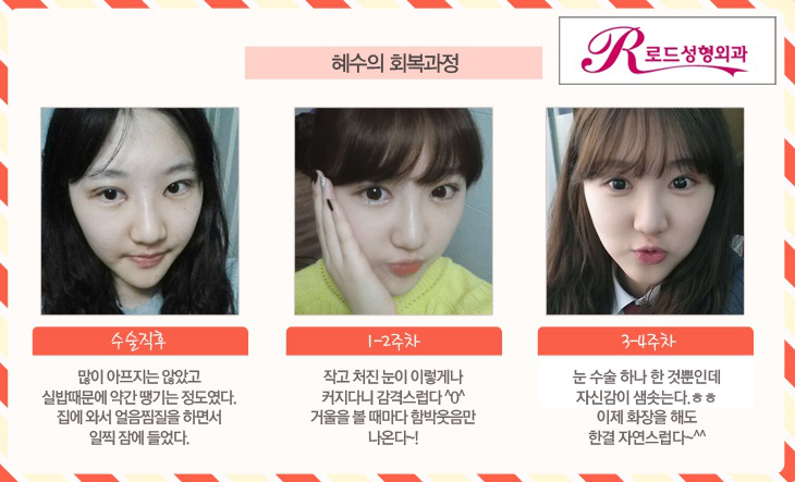 강서구성형외과◎ 로드에서 쌍꺼풀수술 확인해보세요~ 관련 이미지 3