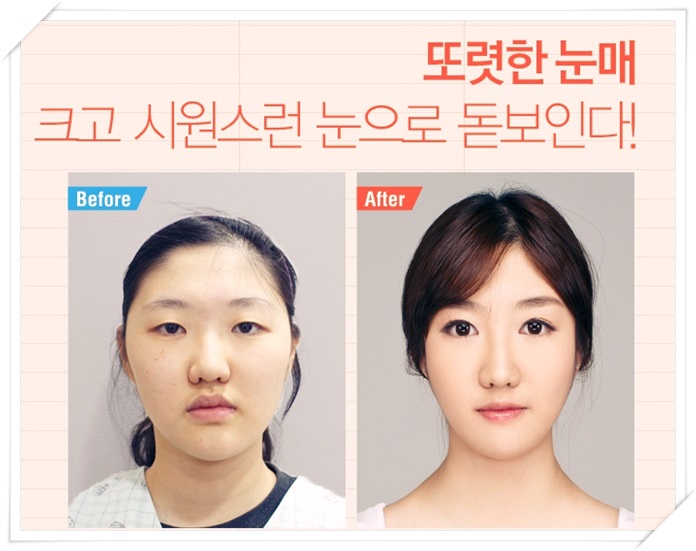 강서구눈성형 한지 모를 자연스러움 관련 이미지 4
