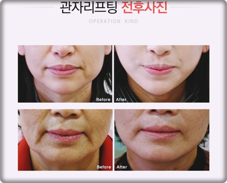 신정역리프팅 로드성형외과에서 해결 관련 이미지 3