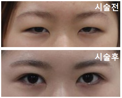 목동쌍꺼풀수술 빠르고 확실한 로드 관련 이미지 4