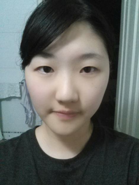 [화곡역성형외과 로드성형외과에서 알려드리는 눈성형 정보 ♬] 관련 이미지 5