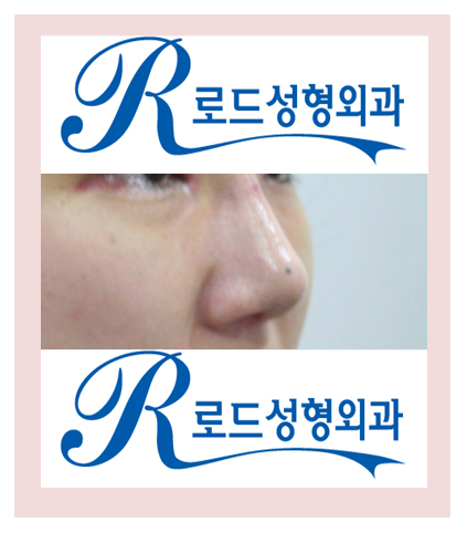 [화곡역성형외과 로드성형외과에서 알려드리는 넓은코성형 정보 ♬] 관련 이미지 5